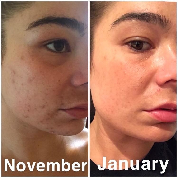 reviewer image of their skin in November vs in January with less blemishes and acne scarring