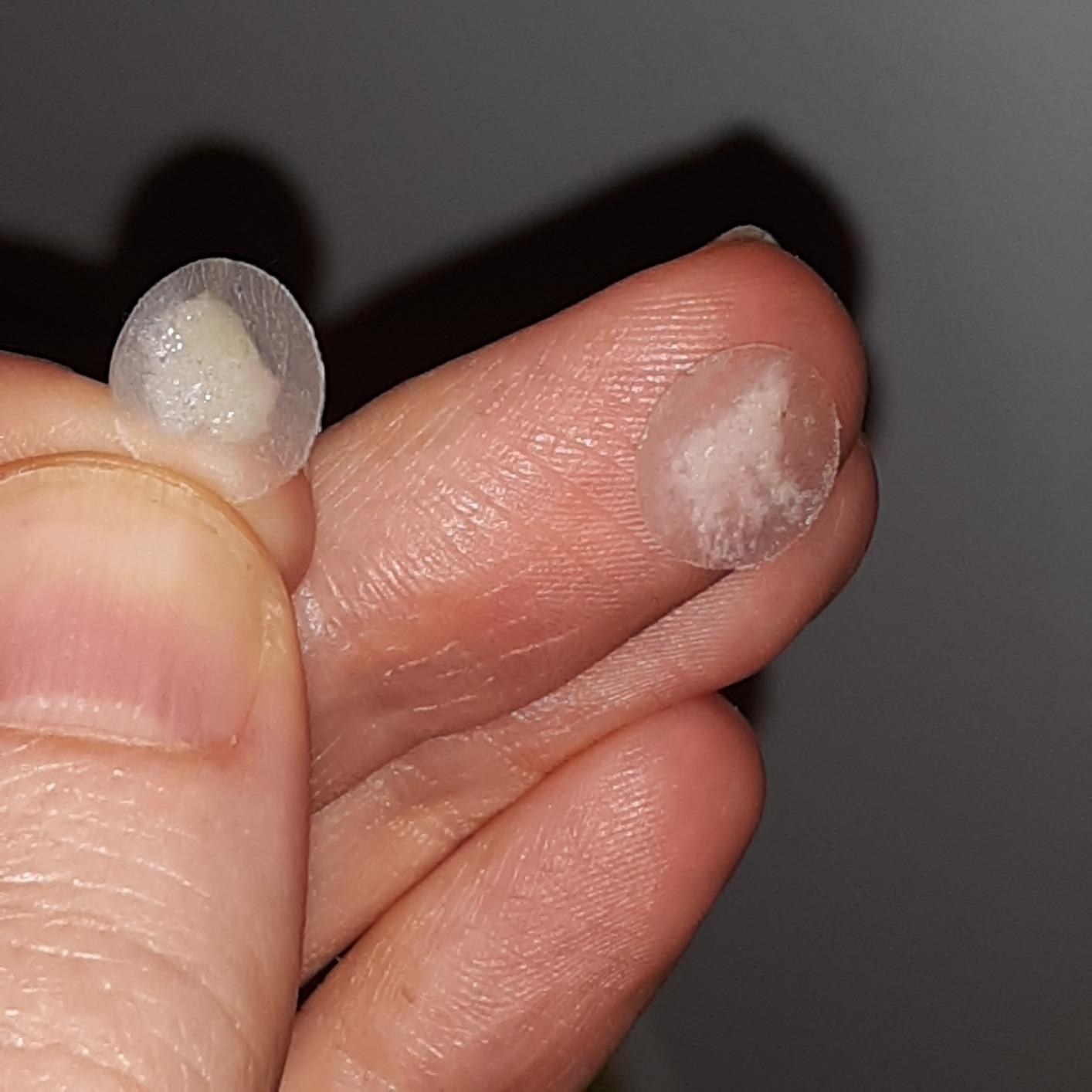 image of two pus filled acne patches on a reviewer&#x27;s fingers