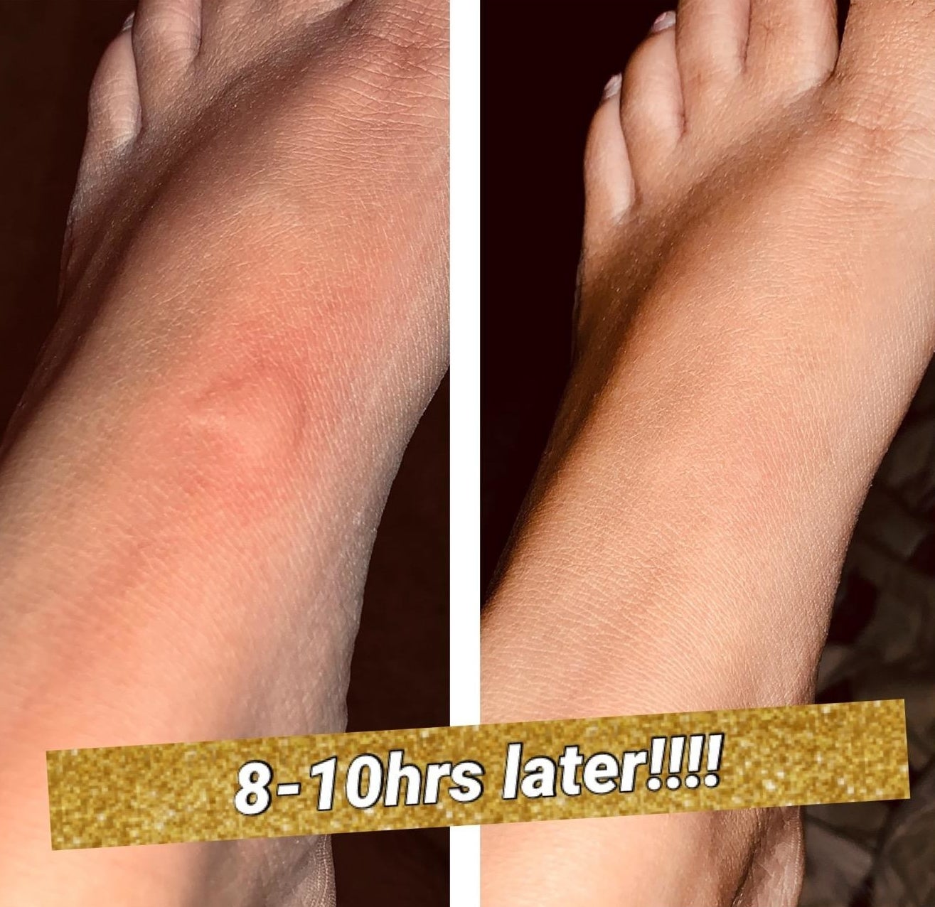 A before and after reviewer photo of a bug bite on a foot