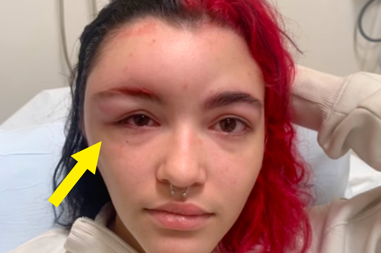 Hair Dye Allergic Reaction Woman S Story On Tiktok