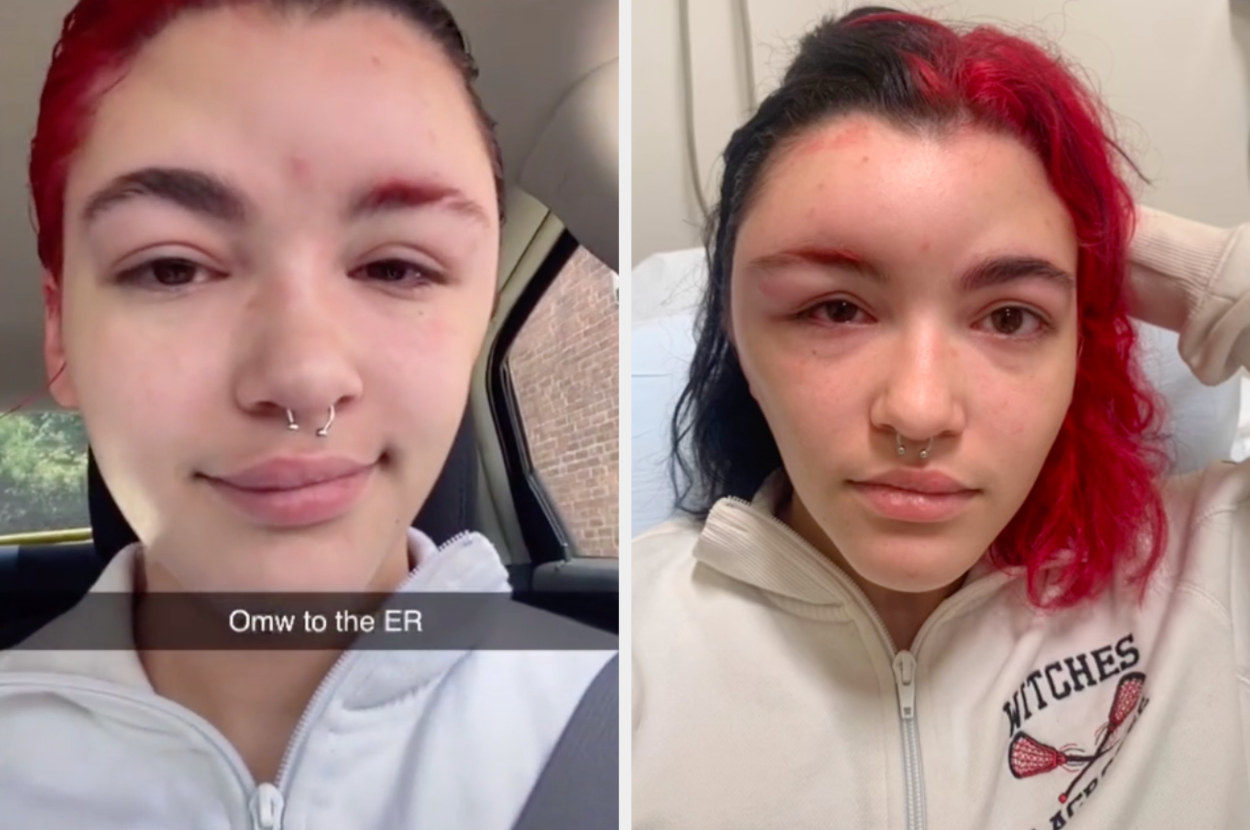 Hair Dye Allergic Reaction Woman S Story On Tiktok