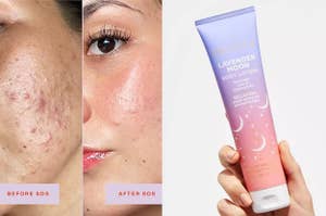 a before and after of a model using Tower28 SOS spray; a model holding a tube of lotion