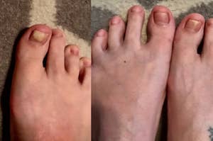 before, reviewer's feet with yellow toenails, and after with toenails a lot less yellow