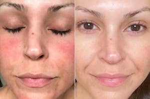 A before/after showing reduced redness and irritation after using the spray