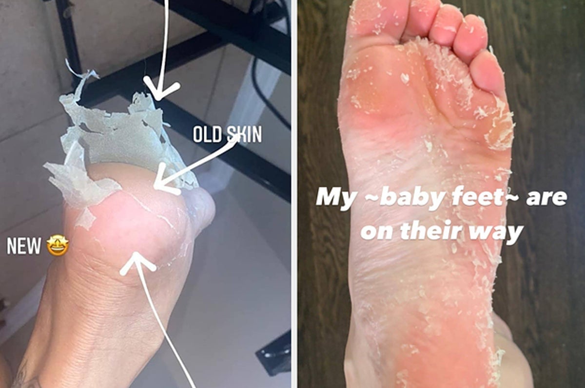 Baby Foot Peel: I Tried It And Here's What Happened
