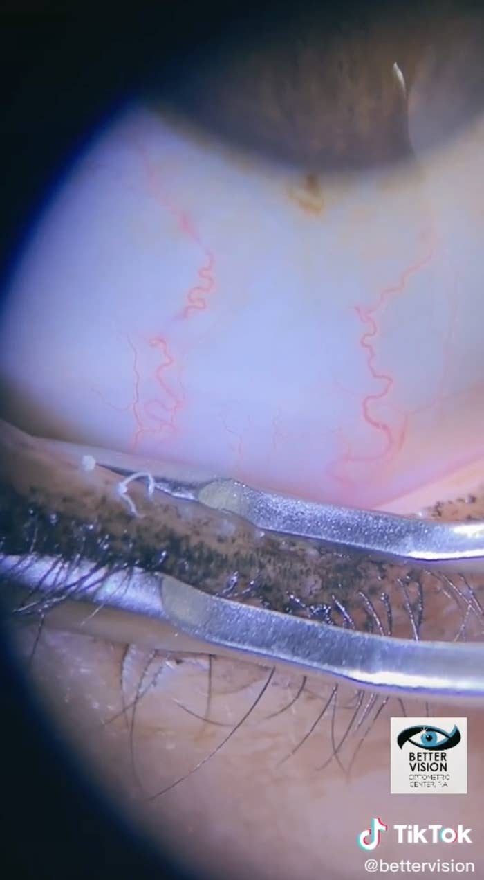 An image of the blocked oil gland