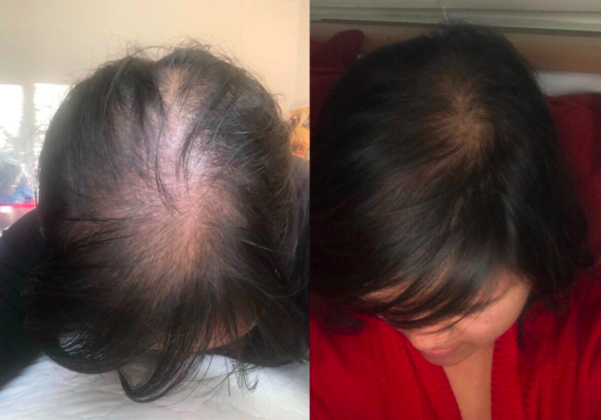 reviewer with balding scalp, then same reviewer with fuller looking hair