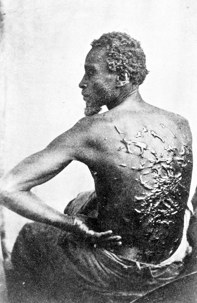 Gordon, also known as &quot;Whipped Peter,&quot; a former enslaved man, shows his scarred back at a medical examination