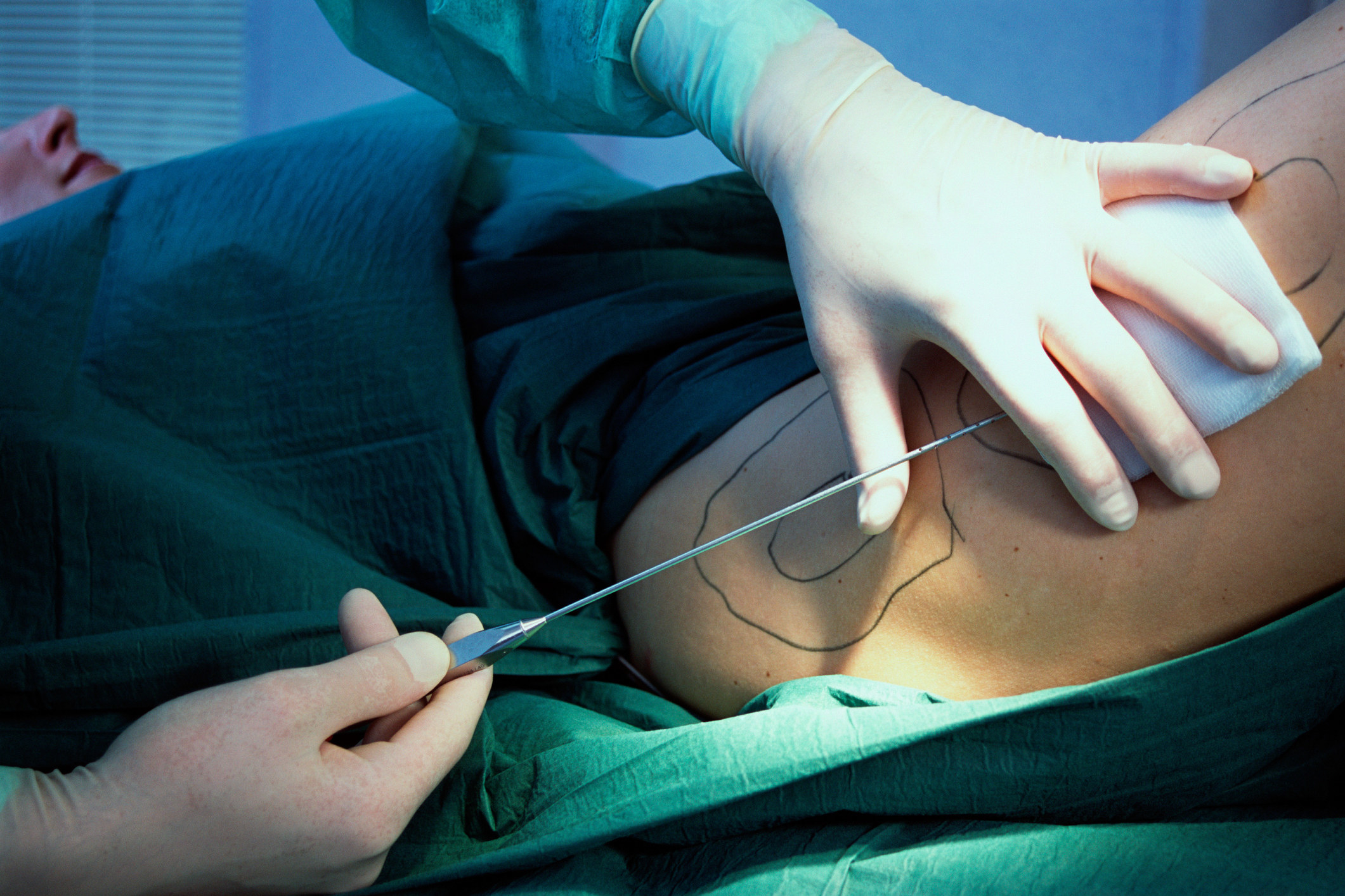 A woman getting liposuction