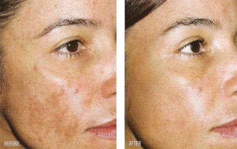 Reviewer's before photo showing melasma on their face and after photo showing melasma gone after using the serum