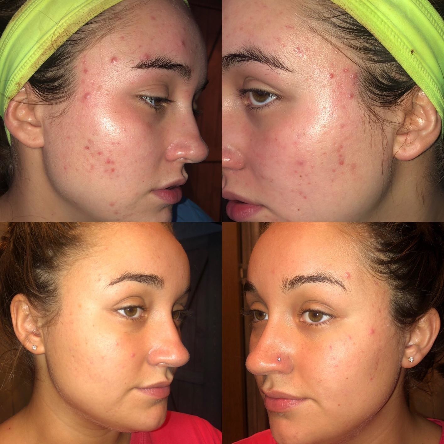four images of a reviewer&#x27;s face getting progressively clearer than the first image where their face is covered in red spots and acne