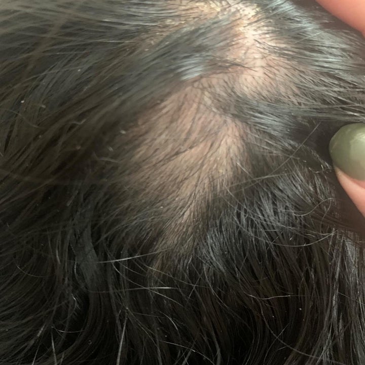 reviewer after image with hair growing back into the bald spot