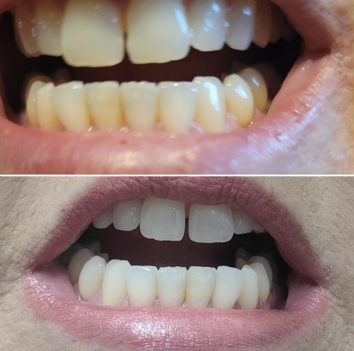 reviewer's photos showing before and after images of yellow and then whiter teeth
