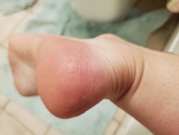 after photo of the same heel looking smooth