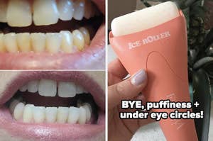 before and after teeth pic and facial ice roller 
