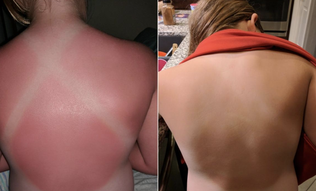 reviewer&#x27;s really burnt back on the left and the same back with just tanned skin on the right