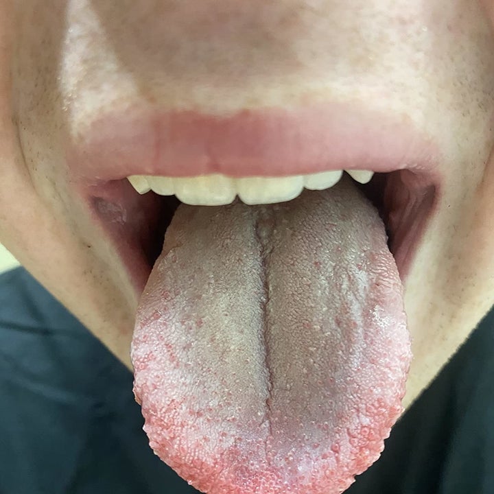 the same reviewer's tongue with the white film scraped off