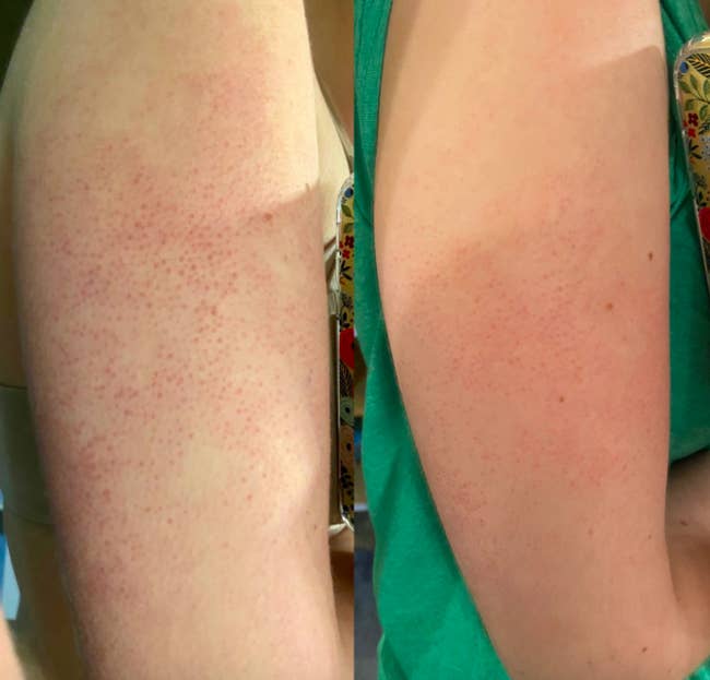 A customer review photo showing their arms before and after using the scrub