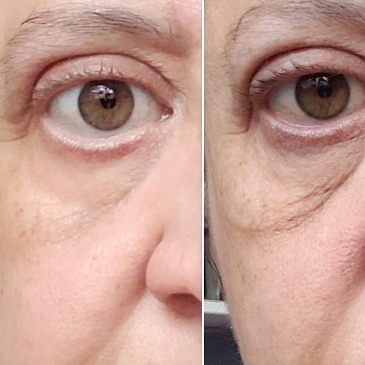 Reviewer before and after showing the eye cream reduced puffiness and dark circles