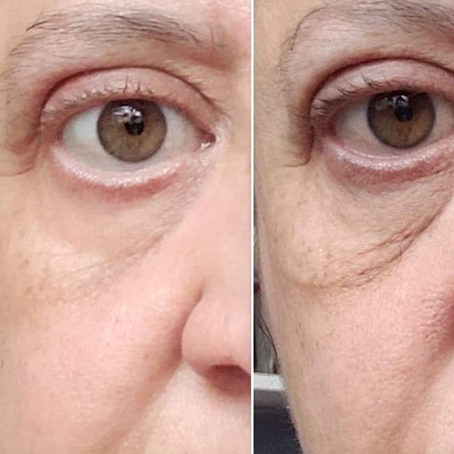 Reviewer earlier and aft showing the oculus pick reduced puffiness and acheronian circles