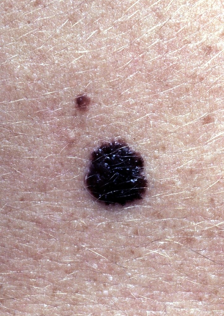 A melanoma