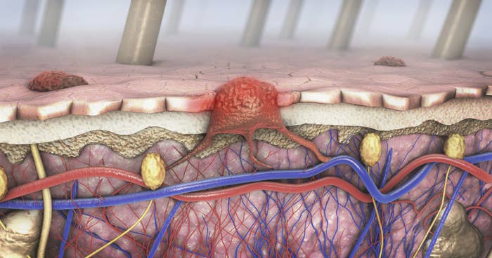 An illustration of melanoma