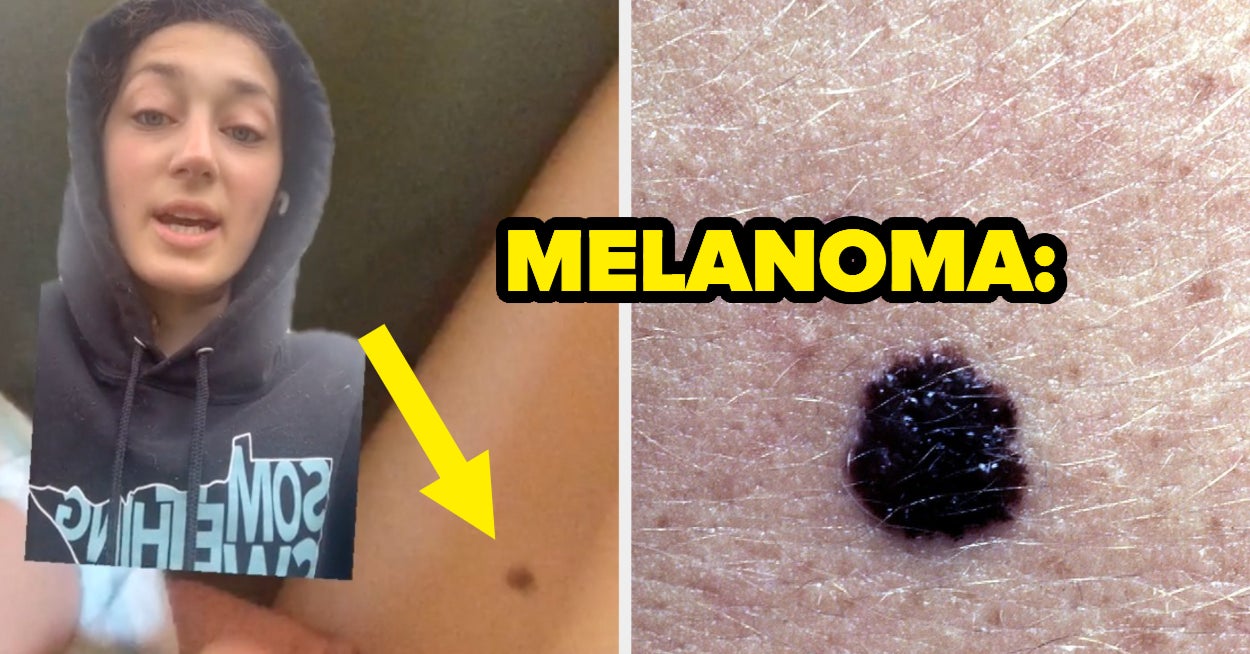 A 27-Year-Old Dying On TikTok Is Sharing Her Melanoma Story