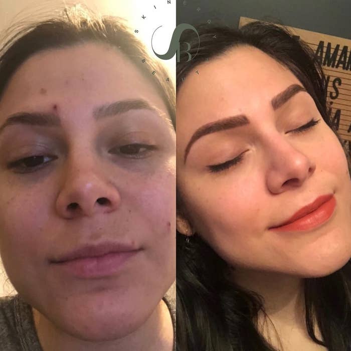 before photo of a reviewer with tired-looking skin and breakouts next to a photo of the same reviewer with clear, plumper-looking skin after using the moisturizer