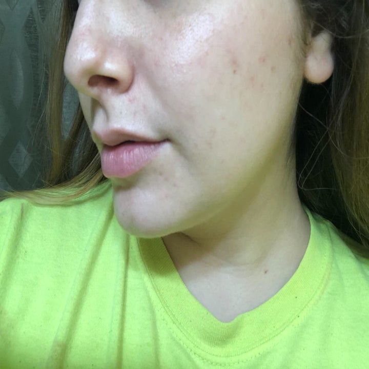 the same reviewer with much clearer skin and the acne is totally gone