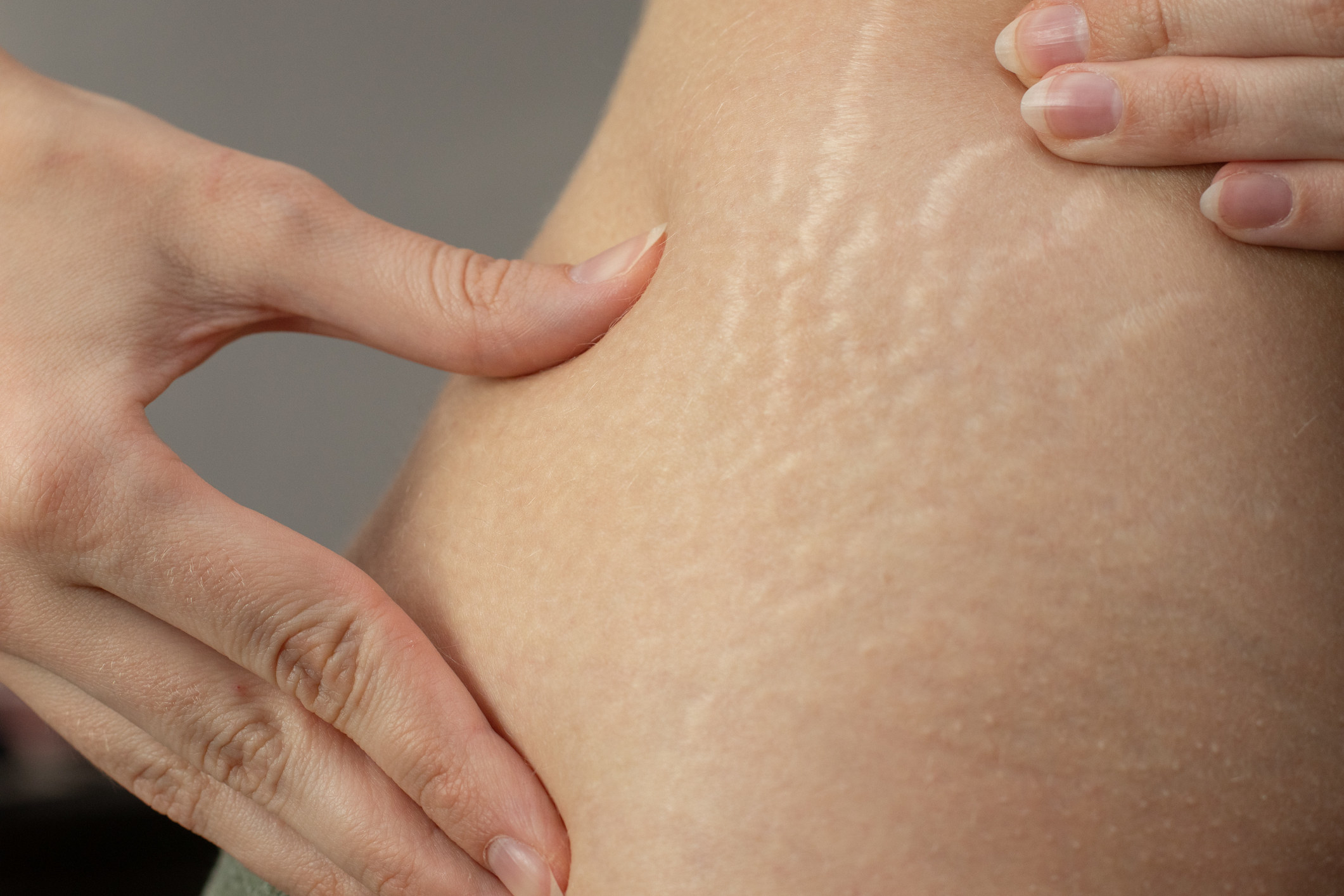 A woman reveals stretch marks on her skin