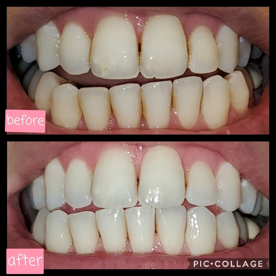 reviewer&#x27;s before and after pics of their teeth with some yellow-brown stains next to them looking noticeably whiter and less stained after using the pen