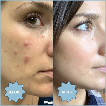 a split image of a reviewer before and after using the acne oil 