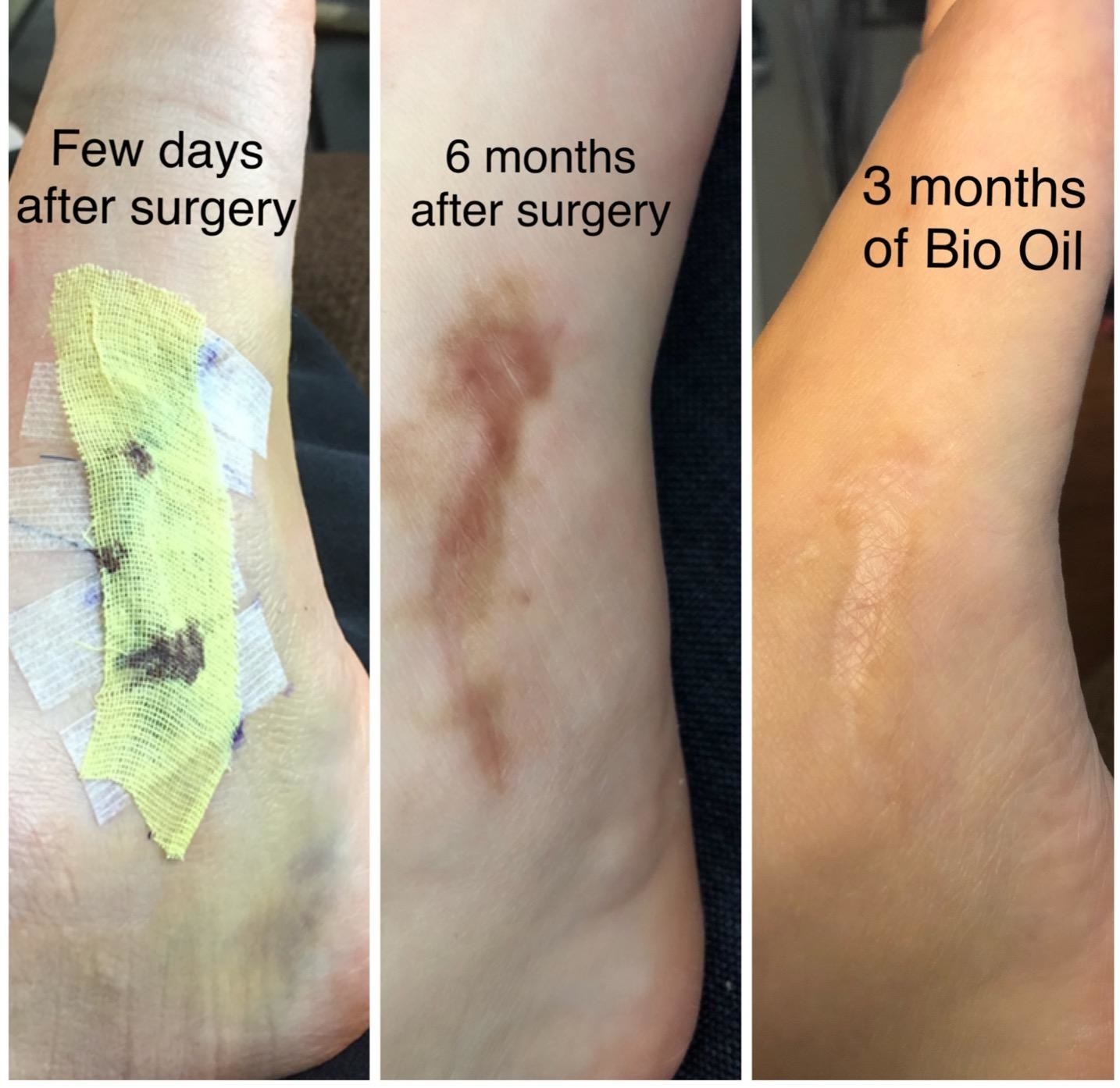 a reviewer image of a scar right after surgery, six months after surgery, and how it faded three months after using the oil 