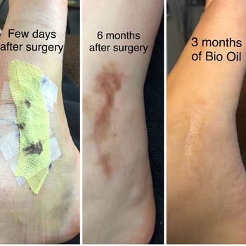 a reviewer image of a scar right after surgery, six months after surgery, and how it faded three months after using the oil 