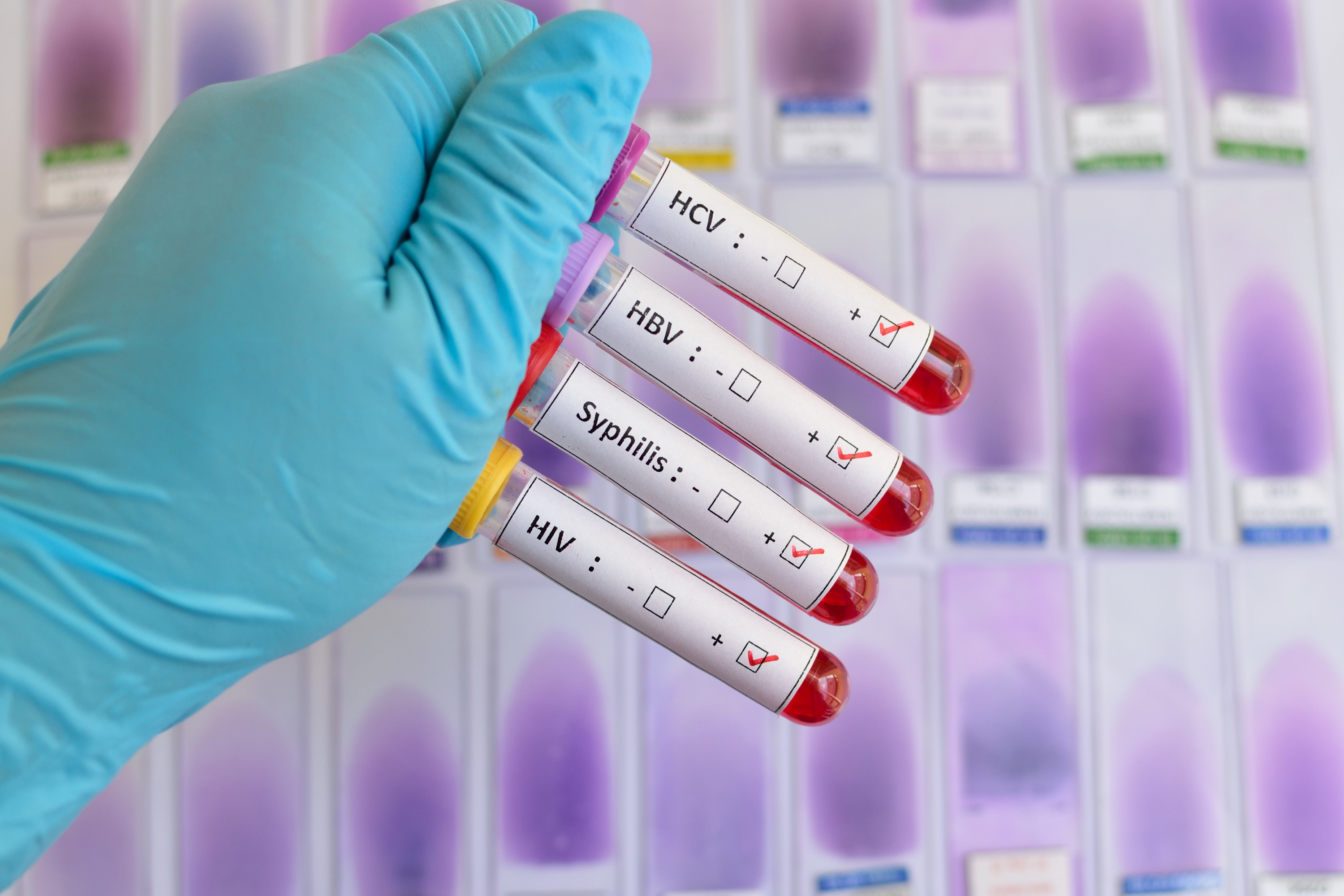 A stock image of a doctor holding up vials of blood for STD testing