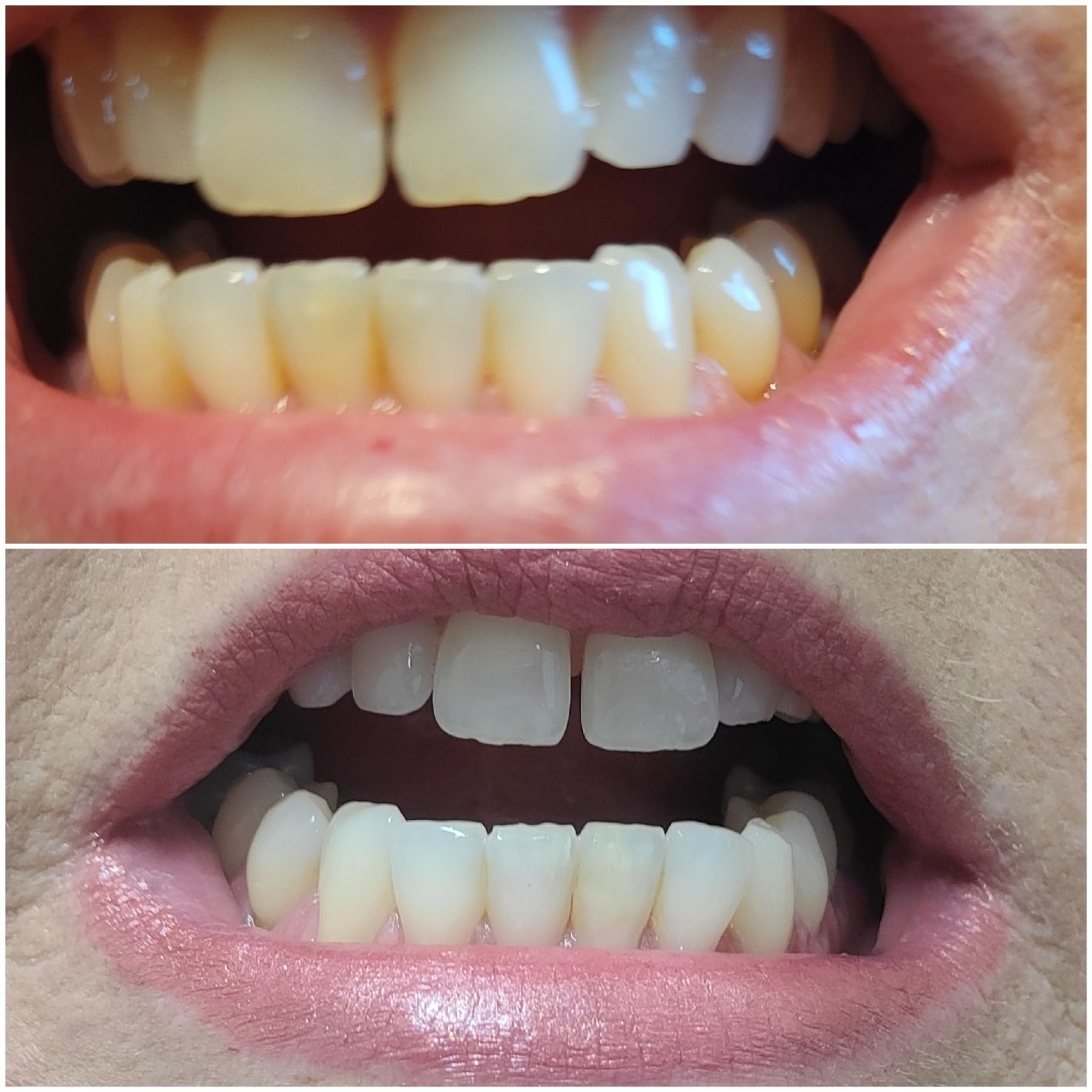 before and after of reviewer&#x27;s yellow teeth, then cleaner whiter teeth after use