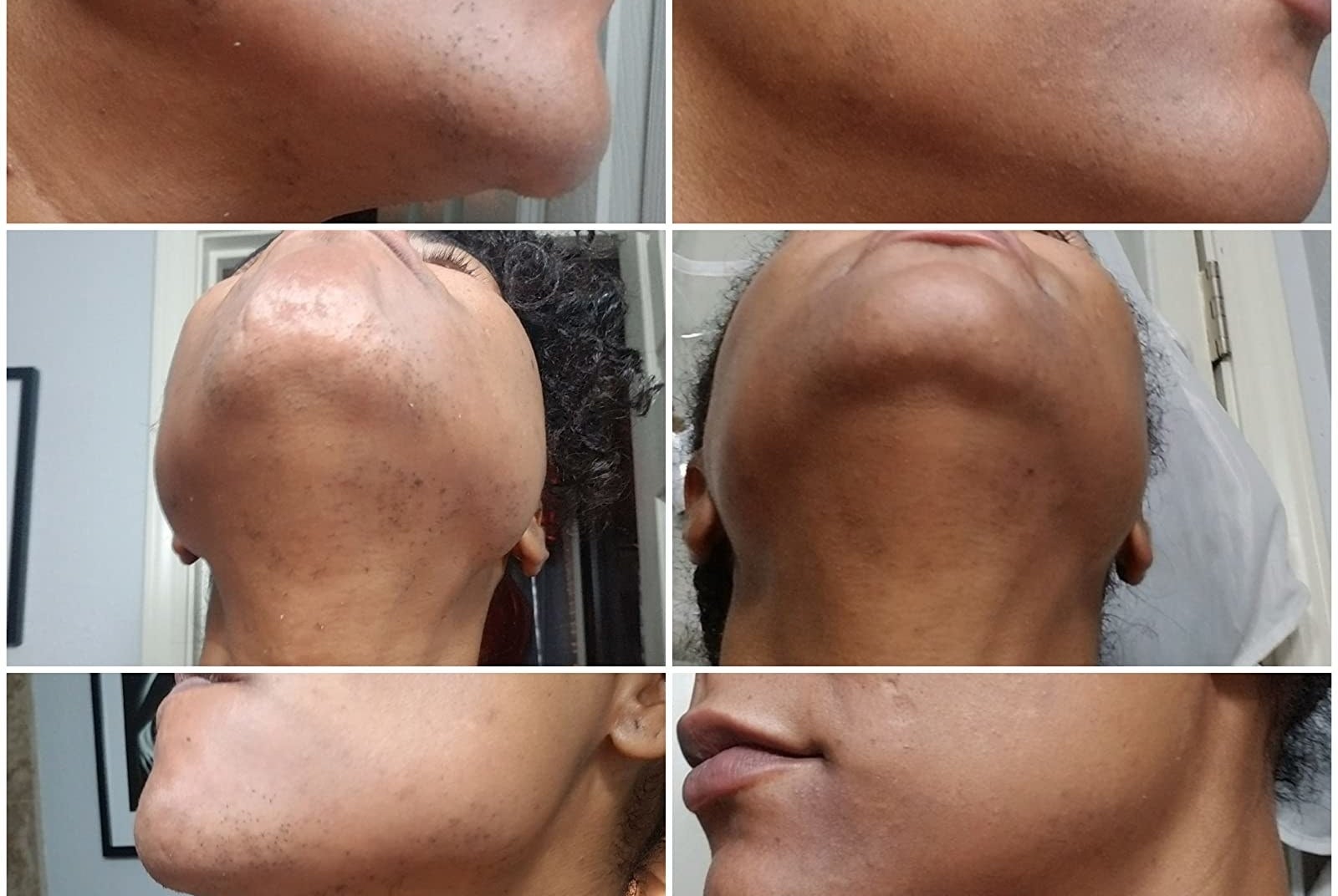 Reviewer showing before-and-after results of using Mederna Scar Cream