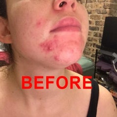 Reviewer photo of skin before using Aztec Secret healing clay