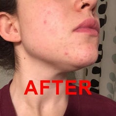 Reviewer photo of skin after using Aztec Secret healing clay