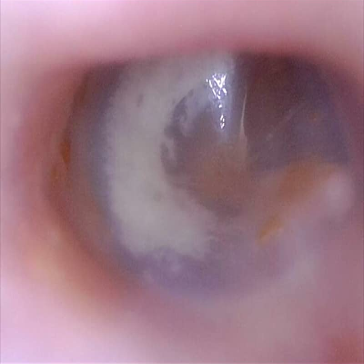 the same ear canal with all of the ear wax removed
