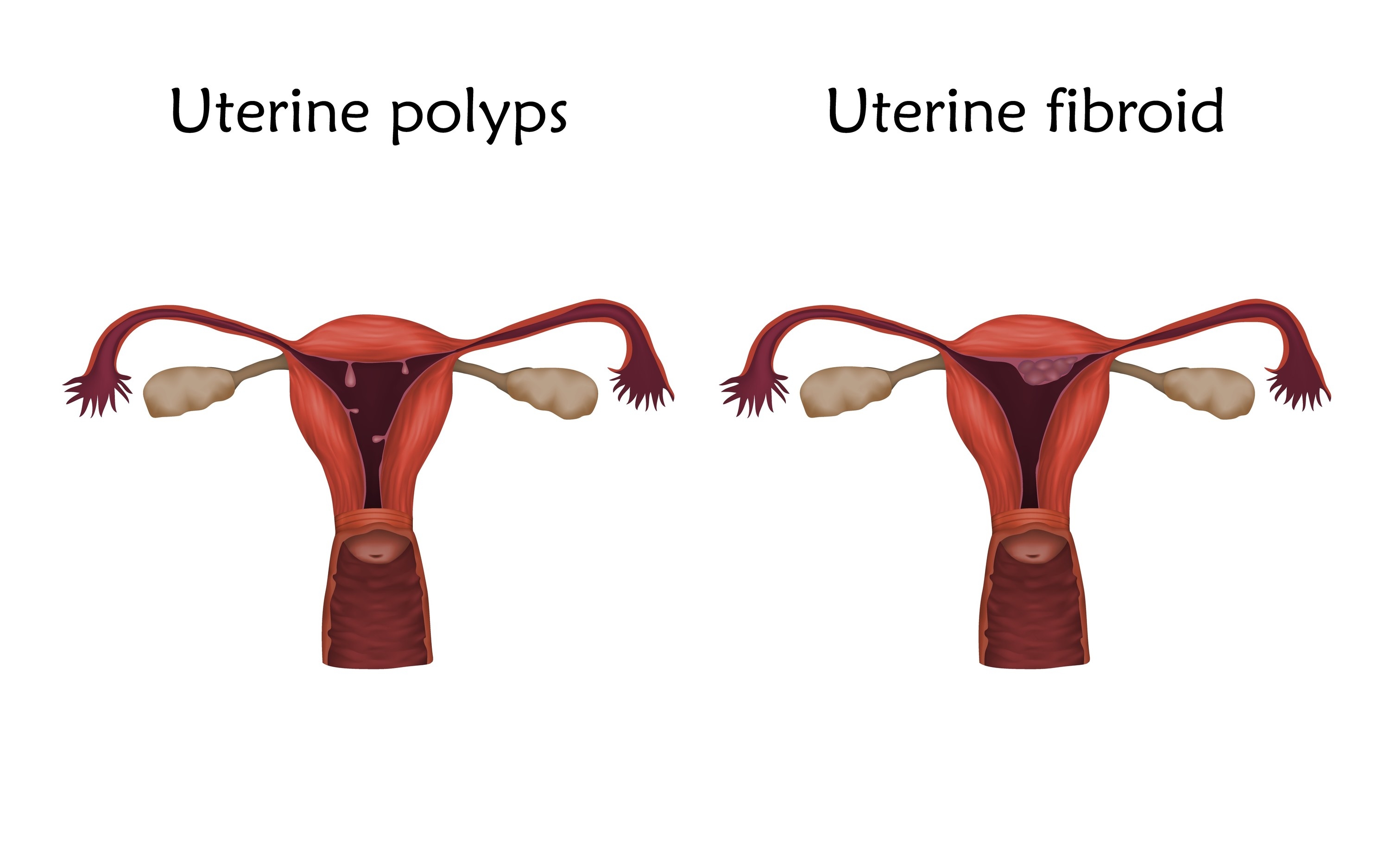 A drawn chart of a uterus with uterine polyps next to a uterus with fibroids