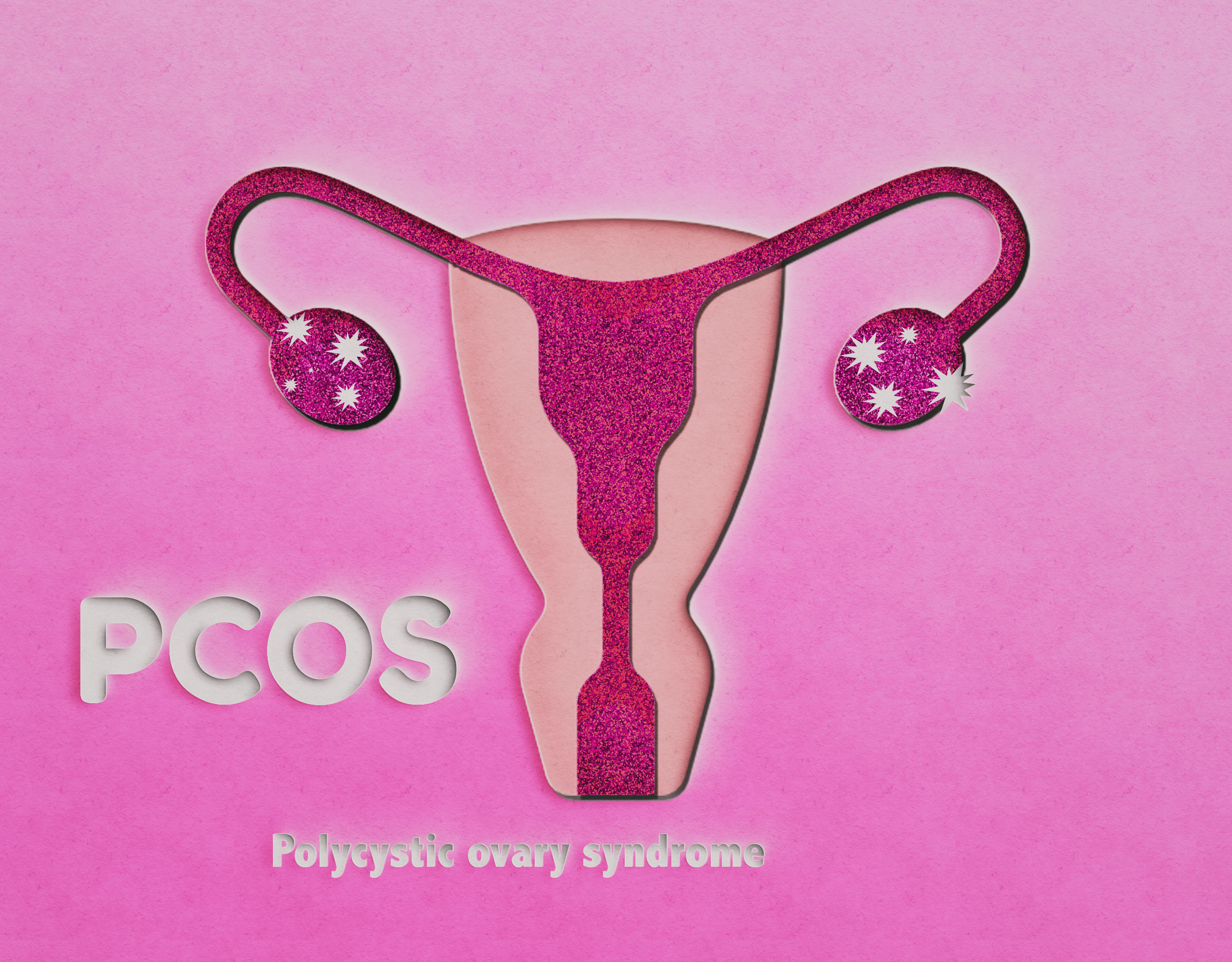 A drawing of the uterus with PCOS