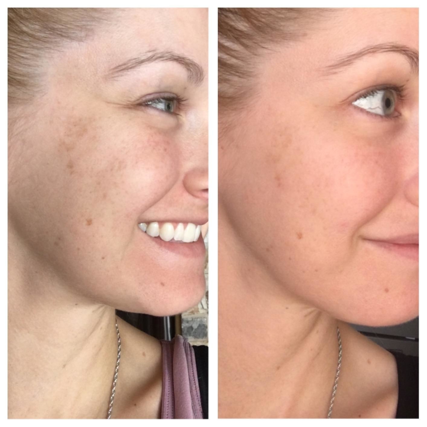 reviewer&#x27;s before-and-after of having a smoother and more even complexion after using