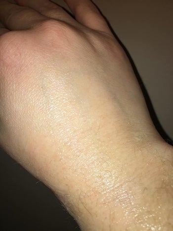 reviewer image of the same wrist with no scar at all