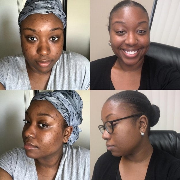 four images of a Black reviewer&#x27;s face getting progressively clearer than the first image where their face is covered in red spots and acne