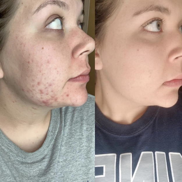 Before and after image of reviewer with cystic acne and without