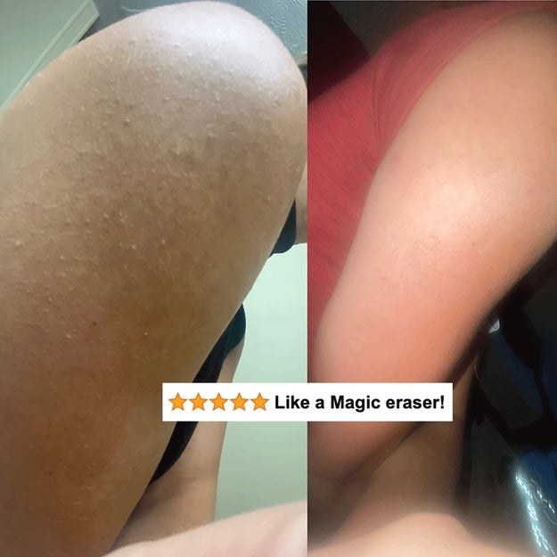 A reviewer&#x27;s before/after showing the bumpy skin that&#x27;s now smooth with five-star review text &quot;like a magic eraser&quot;
