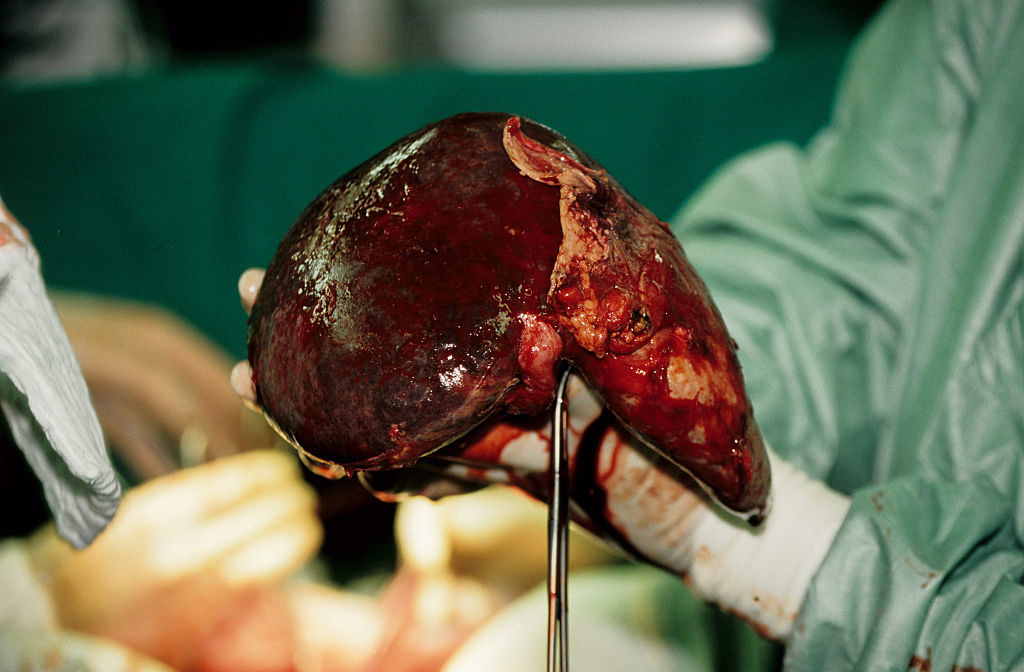 A liver being used for a transplant