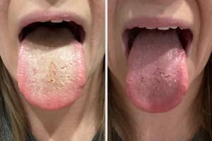 A reviewer's white tongue before using a tongue scraper // Their pink tongue after using the scraper