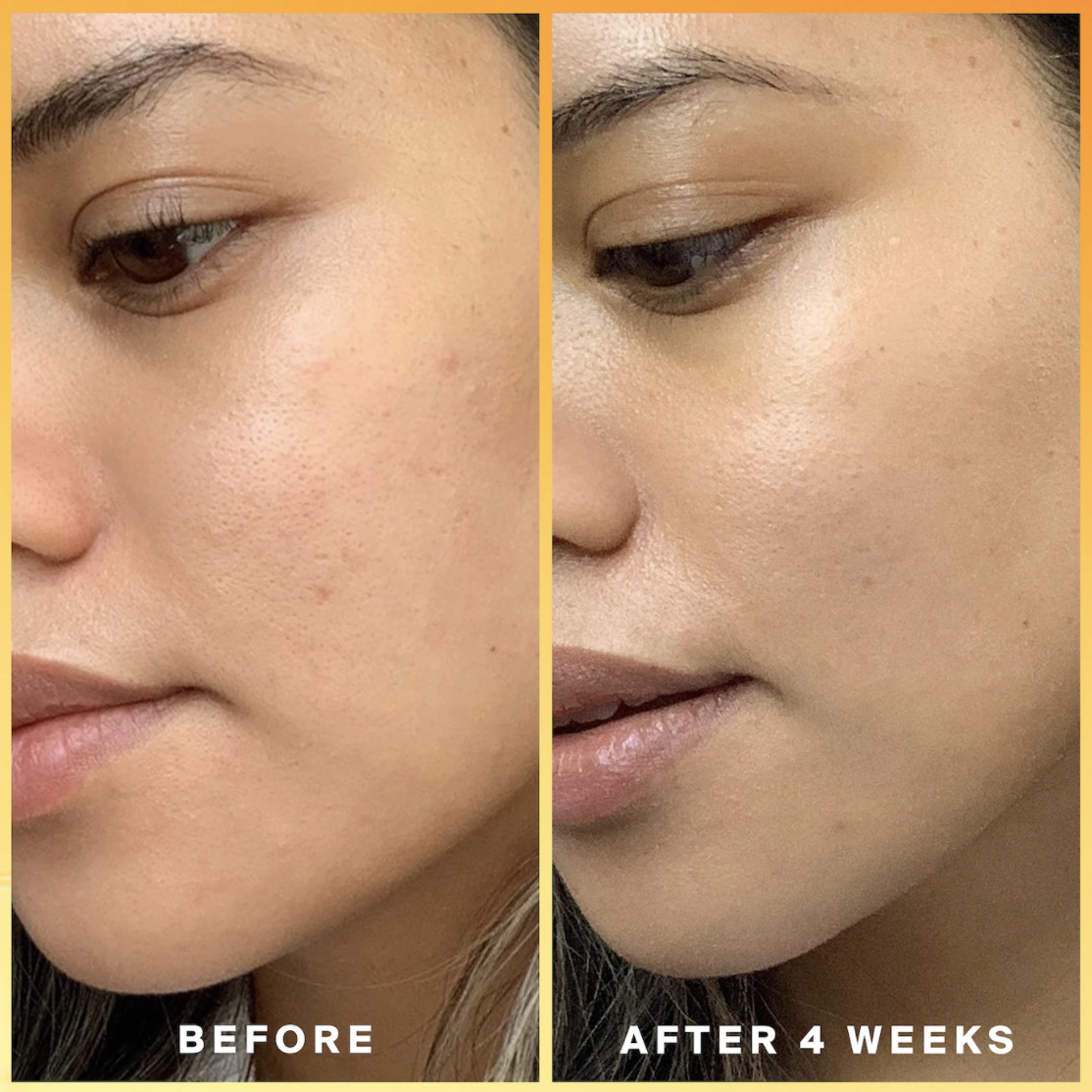 model before and after shot showing a more evened-out complexion after four weeks
